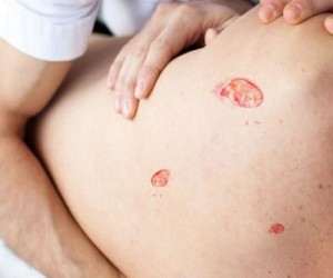 لیزر موهای زائد خیابان گلها گرگان