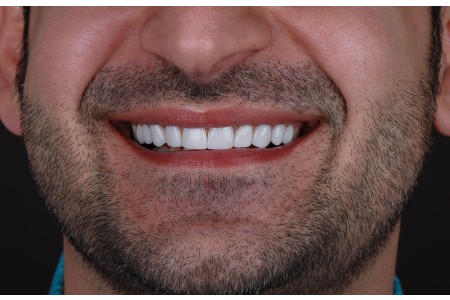 دندانپزشکی عصب کشی کامپوزیت طرح لبخند جرم گیری کشیدن